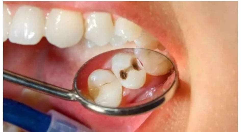 দাঁতে পোকা? সহজ উপায়ে দাঁতের স্বাস্থ্য রক্ষা করুন